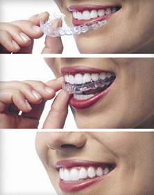 Straighter teeth with invisalign braces